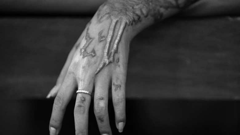 Husband throws acid on Balochistan policewoman in Karachi