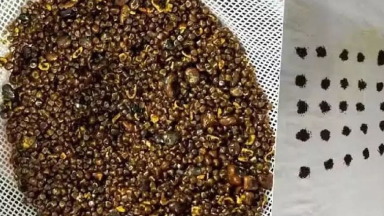 Doctors remove over 6,000 stones from 70-year-old man's gallbladder