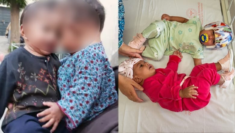 Turkish doctors successfully separate 11-month-old conjoined twins from Pakistan