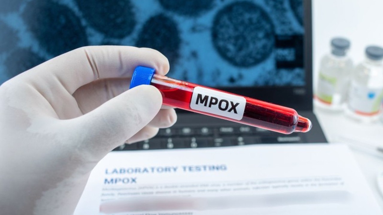 Pakistan reports another monkeypox case