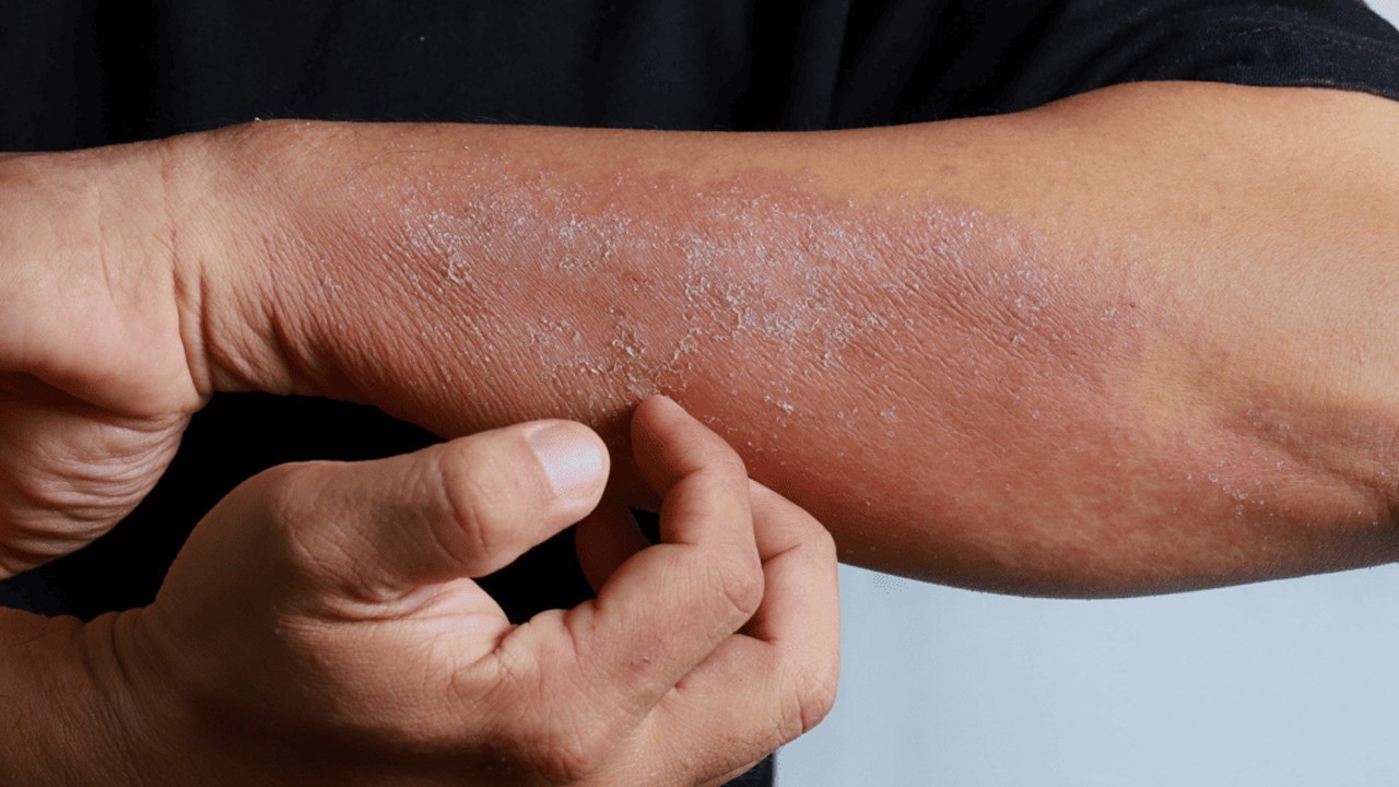 Karachi reports spike in skin disease cases following monsoon rains