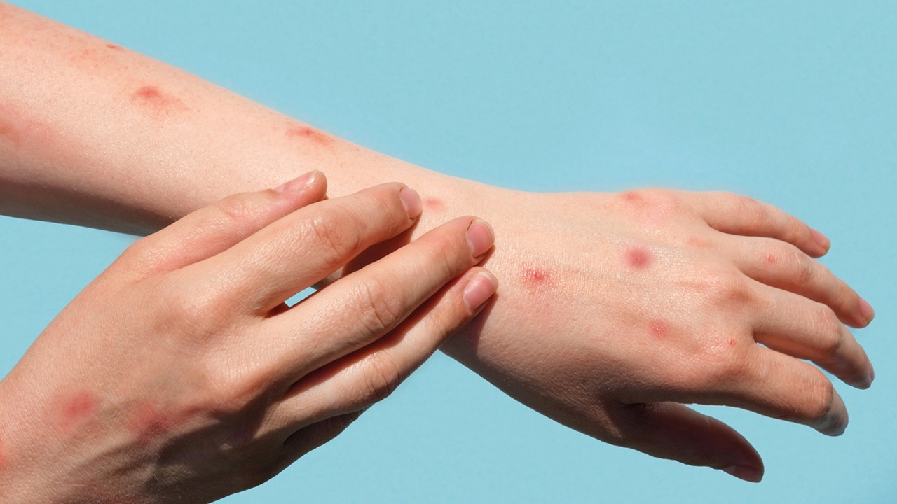 Lahore confirms two new cases of monkeypox