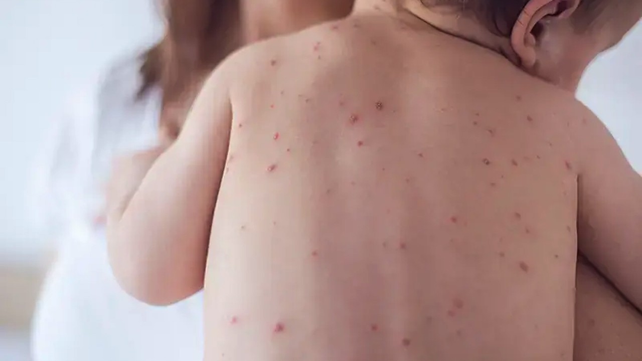 Sindh reports 63 measles, 20 diphtheria and 5 tetanus deaths among children in eight months