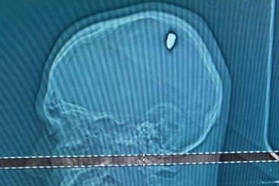 سر میں لگنے والی چوٹ کا انکشاف ہونے پر شہری کے پیروں تلے زمین نکل گئی