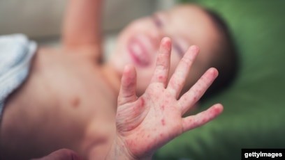 خیبرپختونخوا میں خسرہ نے وبا کی صورت اختیار کرلی، 22 اموات