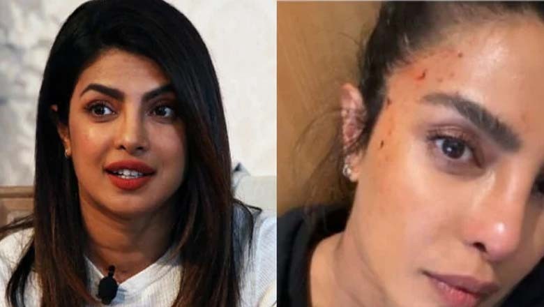 پریانکا چوپڑا شدید زخمی، خون بہنے کی تصاویر شیئر کردیں