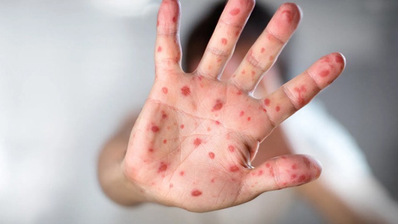 خسرہ کی وبا پھیلنے لگی، پانچ بچے دم توڑ گئے