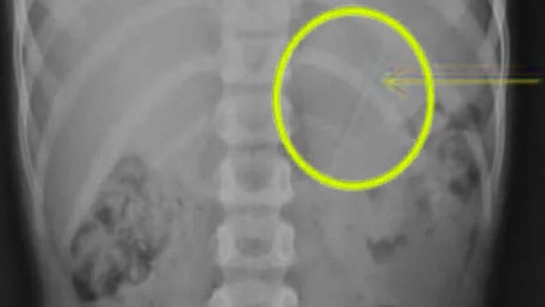 لڑکے نے حادثاتی طور پر پنسل ہضم کرلی