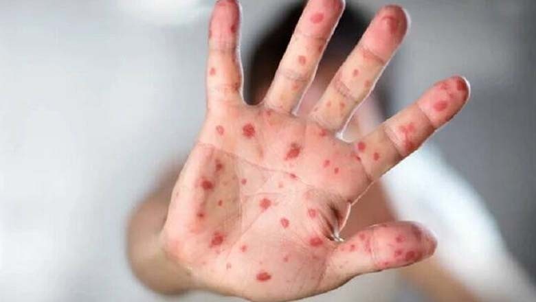 بھکر میں خسرہ کی وبا پھیلنے لگی، ضلع بھر میں ایمرجنسی نافذ