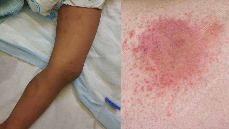 لاہور: باپ کے کاٹنے سے بچے کے جسم میں زہر پھیل گیا