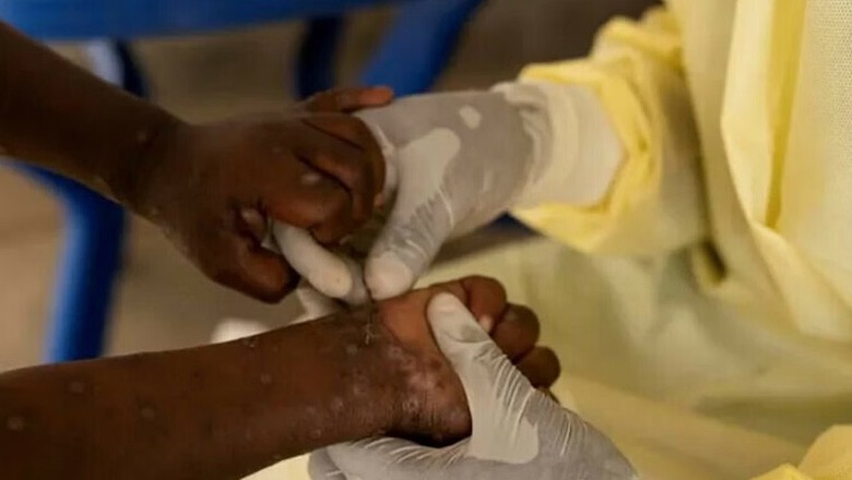 منکی پاکس کی خطرناک قسم افریقا سے باہر پہنچ گئی، پہلا کیس کس ملک میں روپورٹ ہوا؟