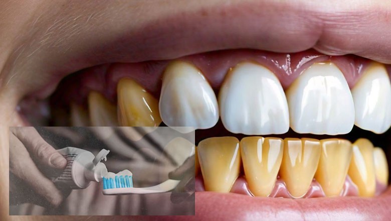 ٹوتھ پیسٹ کے استعمال سے دانت سفید نہیں ہوتے بلکہ ۔۔۔ امریکی ڈاکٹر کا پیغام