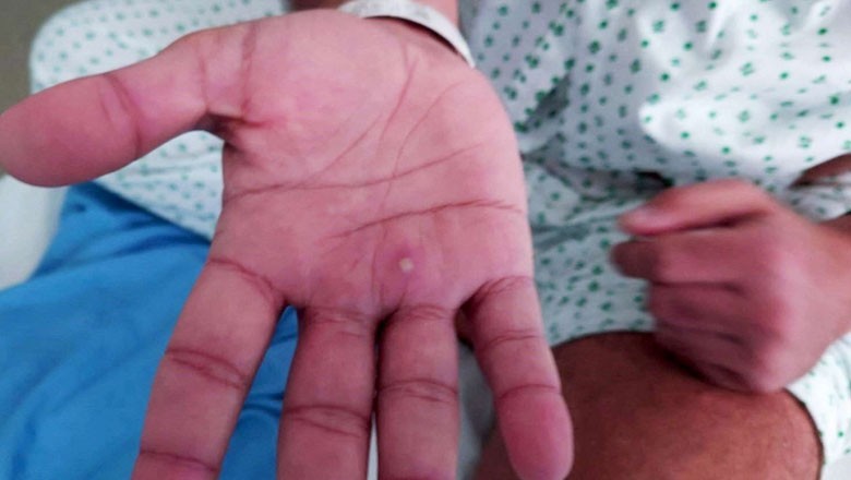 کراچی ایئرپورٹ آنے والے مسافر کو منکی پاکس کی تشخیص