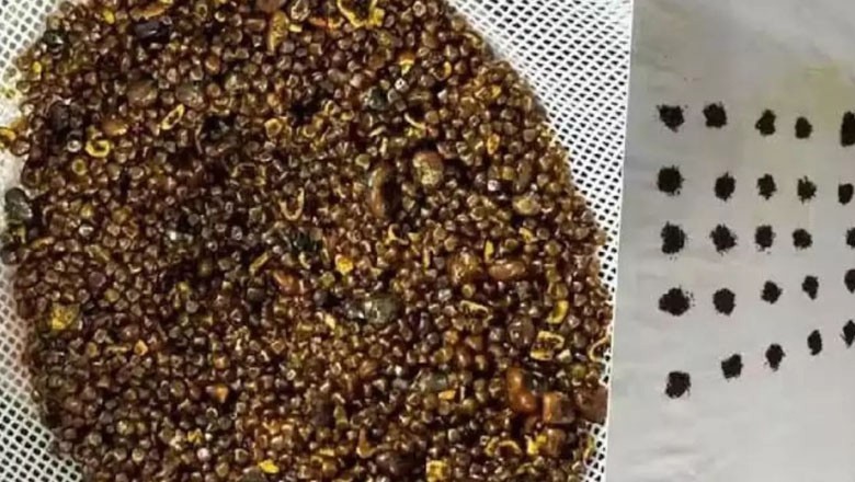 70 سالہ بزرگ کے پتے سے 6 ہزار پتھر برآمد