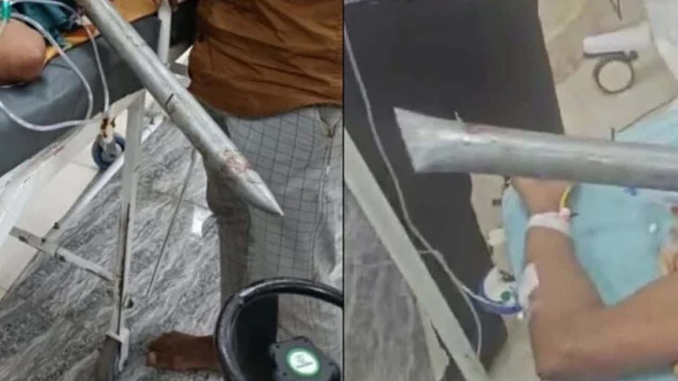 ڈاکٹروں نے مریض کے سینے سے ساڑھے 3 فٹ لمبا لوہے کا پائپ نکال دیا