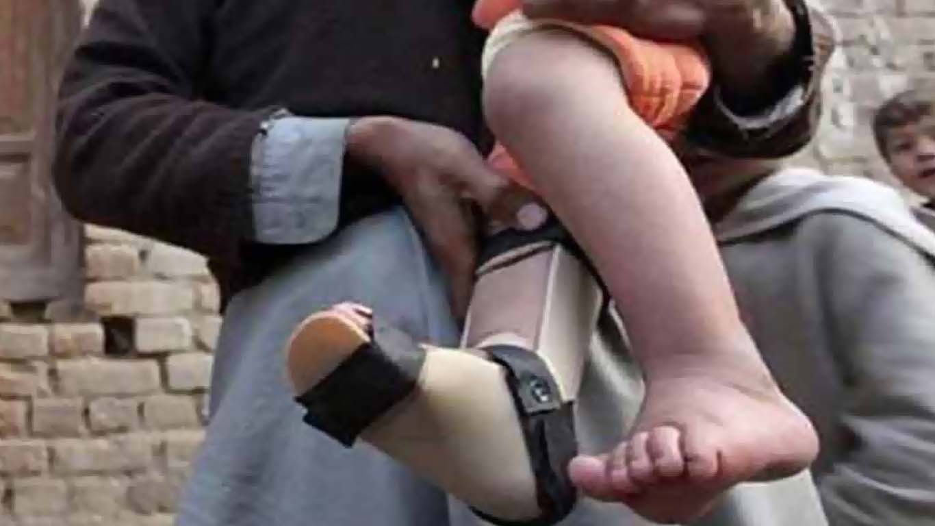 قلعہ سیف اللہ سے پولیو کا ایک اور کیس رپورٹ ہوگیا