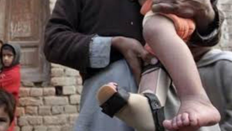 پاکستان میں پولیو کا 73واں کیس سامنے آگیا