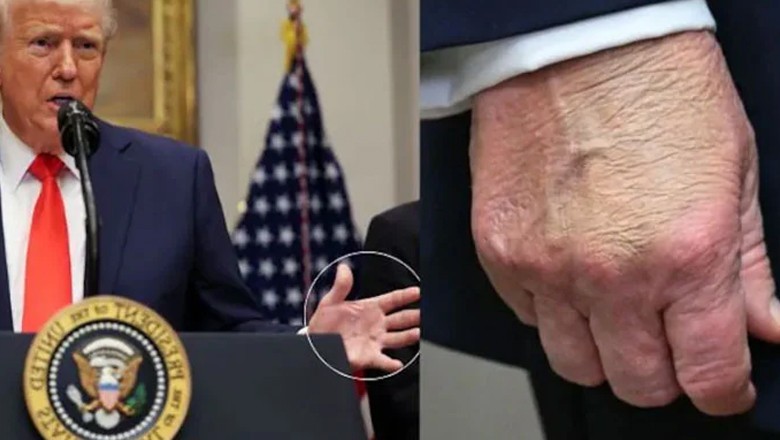 ٹرمپ کے ہاتھ پر چوٹ اور نیل کا نشان، چہ مگوئیاں شروع