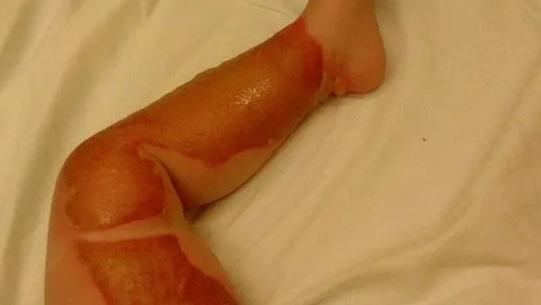 کنگا رام اسپتال میں عملے کی غفلت سے نومولود بچی جھلس گئی