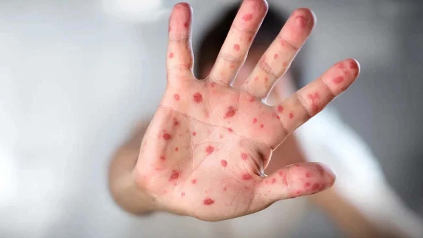 کراچی سمیت سندھ بھر میں خسرہ کی وبا پھیل گئی