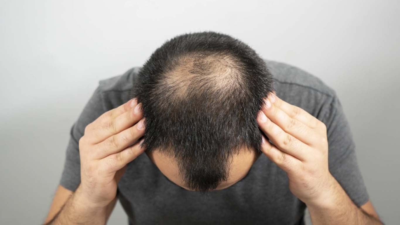 پاکستان میں 70 فیصد نوجوان کم عمری میں ہی گنج پن کا شکار