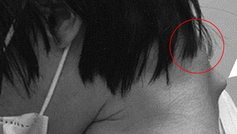 موبائل کے زیادہ استعمال نے نوجوان کی گردن میں ہڈی کا ابھار بنا دیا، سر اٹھانے سے قاصر