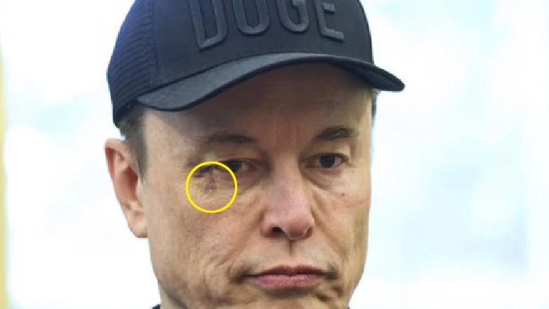 ایلون مسک کی آنکھ پر مکا مارنے کی تصدیق، مگر یہ کس نے مارا؟