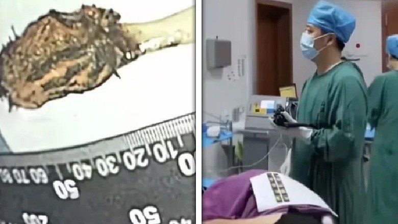 64 سالہ شہری کے پیٹ میں پھنسا ٹوتھ برش 52 برس بعد نکال لیا گیا