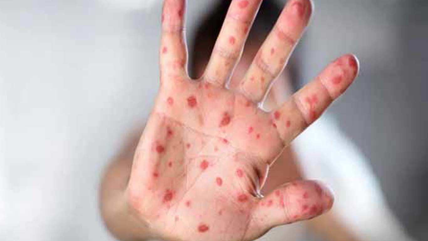 سانگھڑ میں خسرے کی وبا خطرناک حد تک پھیل گئی، 2 بچے جاں بحق