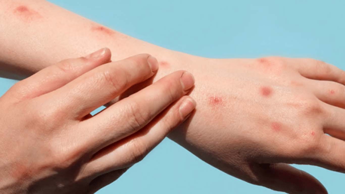 منکی پاکس کراچی پہنچ گیا