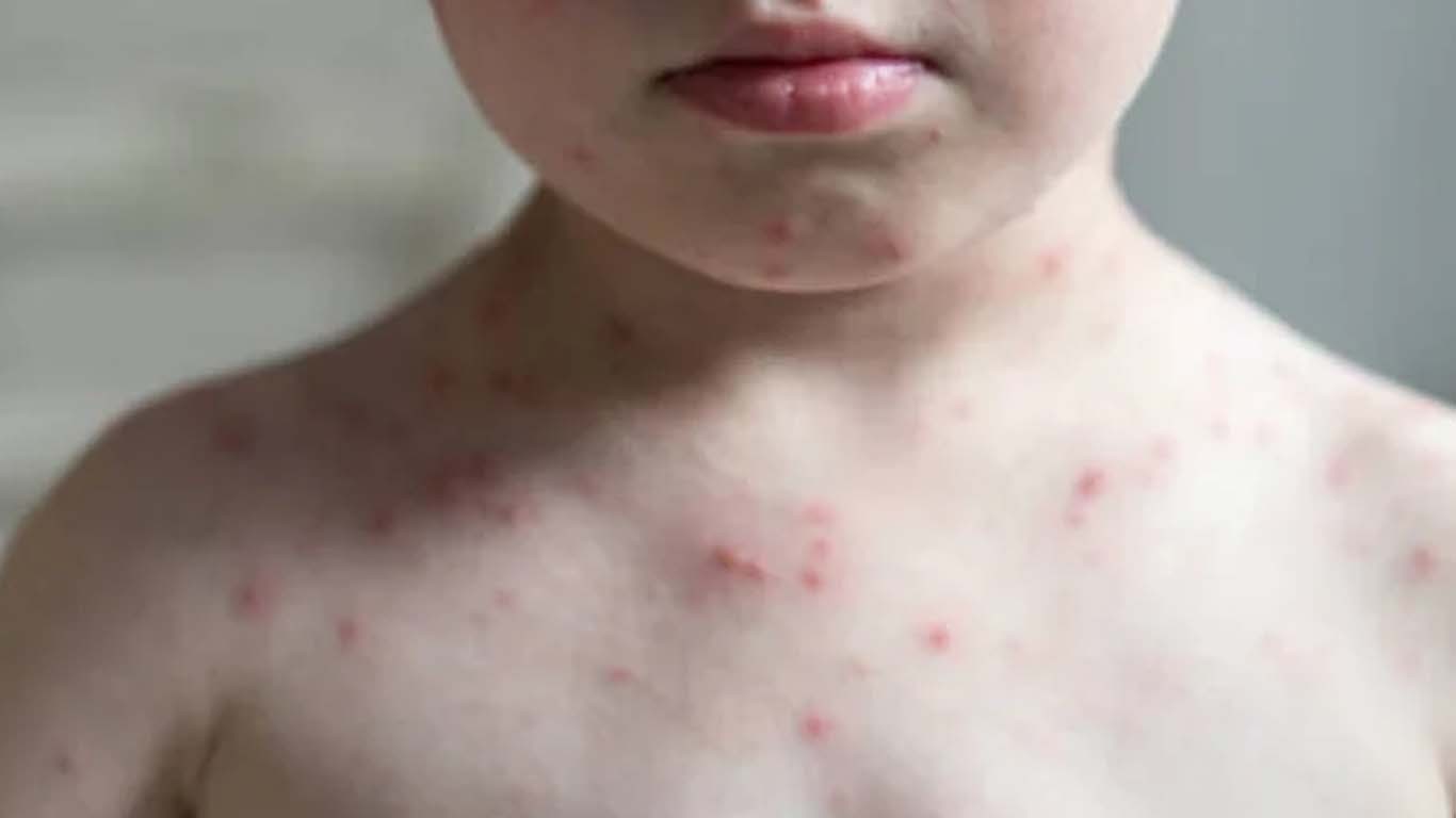 خیرپور اور سکھر میں جِلدی امراض پھیلنے سے7 بچے جاں بحق