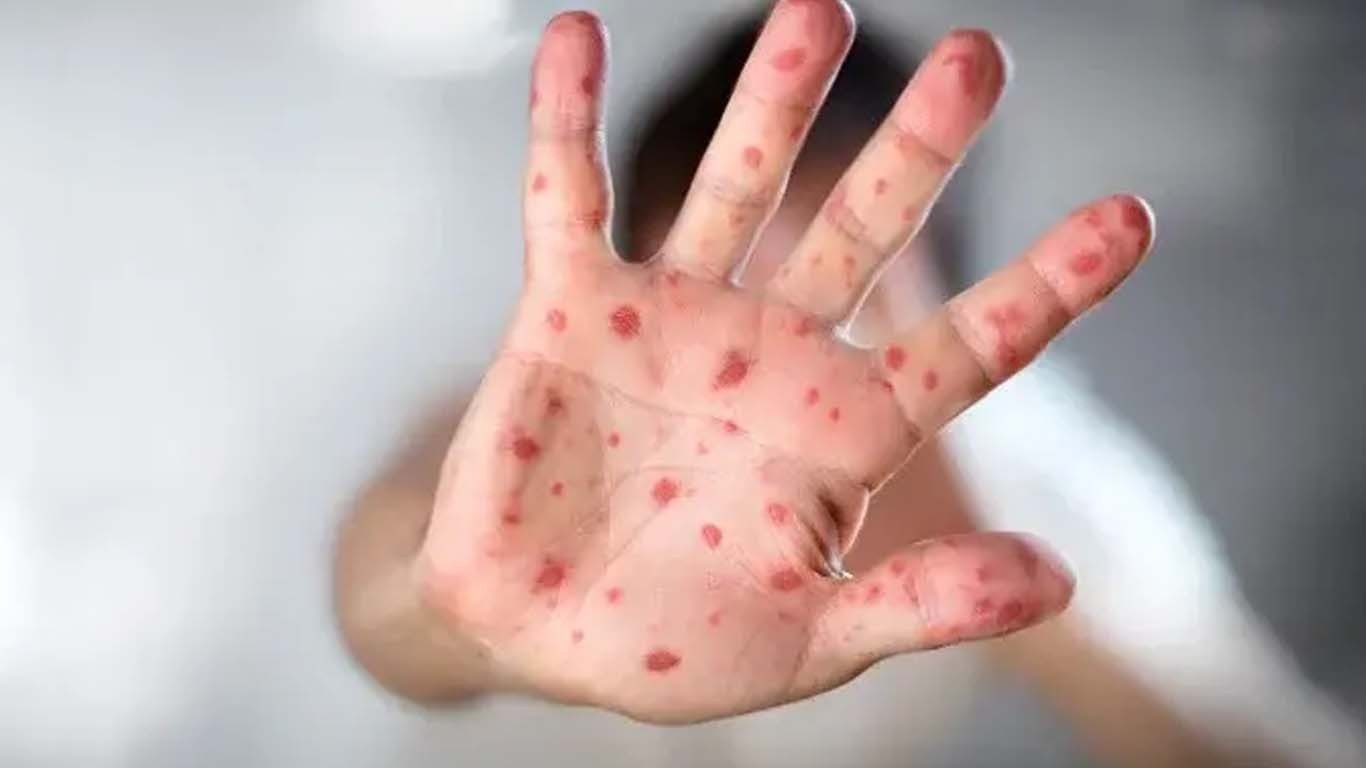 ملک بھر میں خسرے سے 71 افراد جان سے گئے